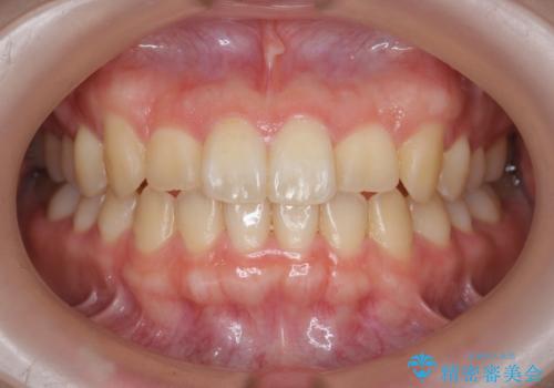 前歯のねじれを改善　小矯正+マウスピース矯正インビザラインの症例 治療後