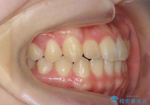 前歯のねじれを改善 小矯正+マウスピース矯正インビザラインの治療後