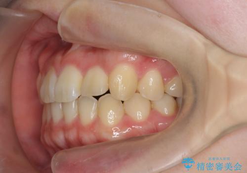 前歯のねじれを治したい (部分矯正を併用したマウスピース矯正)の治療後