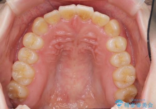 前歯のねじれを治したい (部分矯正を併用したマウスピース矯正)の治療後