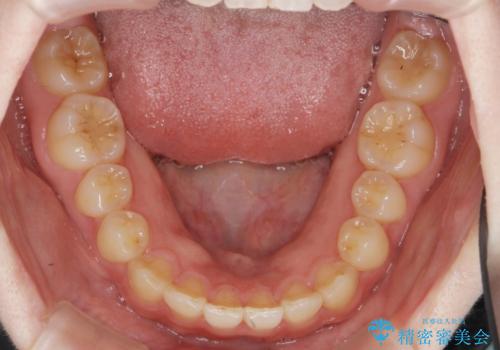 前歯のねじれを改善　小矯正+マウスピース矯正インビザラインの治療後