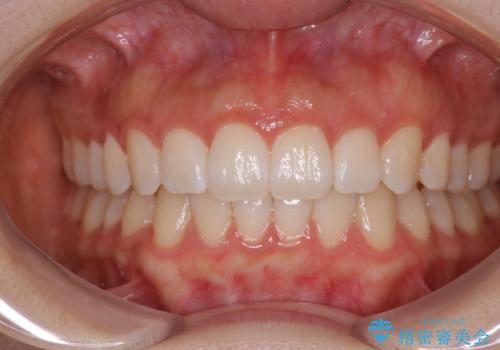 前歯のがたつきをインビザラインで目立たない矯正の治療後