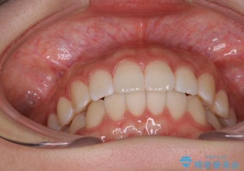 前歯のがたつきをインビザラインで目立たない矯正の治療後