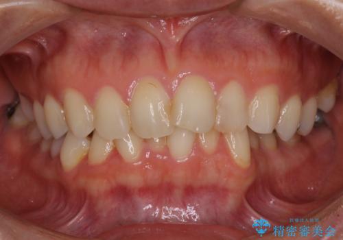前歯の叢生をいつの間にか改善 インビザラインによる矯正治療の治療前