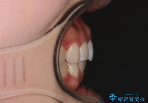 前歯のがたつきをインビザラインで目立たない矯正の治療後