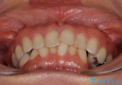 前歯の叢生をいつの間にか改善 インビザラインによる矯正治療の治療前