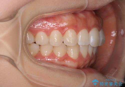 前歯のがたつきをインビザラインで目立たない矯正の治療後