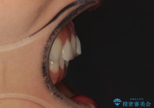 前歯の叢生をいつの間にか改善 インビザラインによる矯正治療の治療前