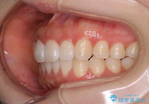 前歯のがたつきをインビザラインで目立たない矯正の治療後