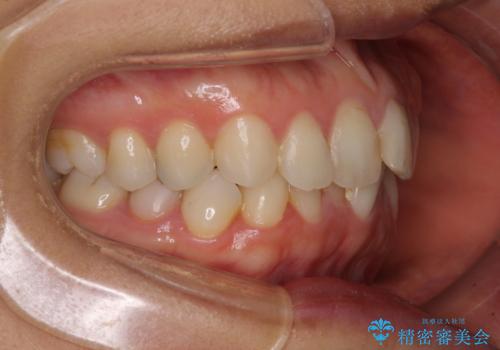 前歯の叢生をいつの間にか改善　インビザラインによる矯正治療の治療前