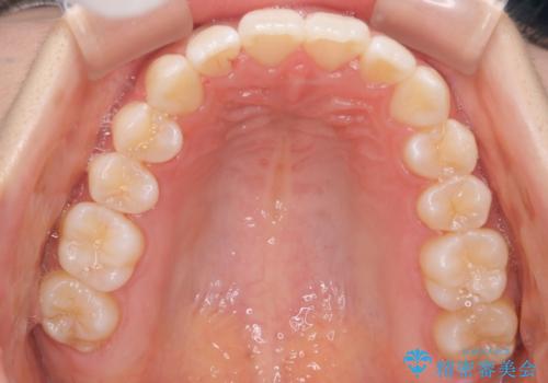 前歯のがたつきをインビザラインで目立たない矯正の症例 治療後