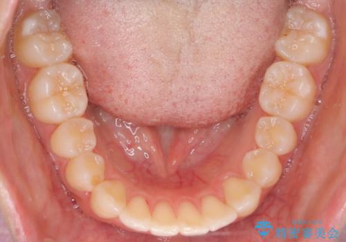 前歯のがたつきをインビザラインで目立たない矯正の治療後