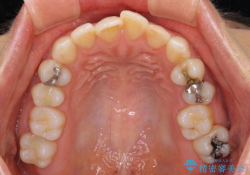 前歯の叢生をいつの間にか改善　インビザラインによる矯正治療の治療前