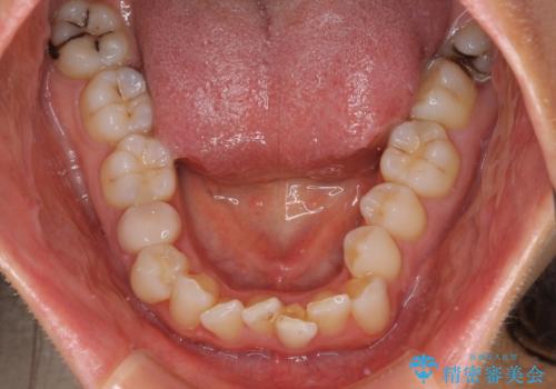 前歯の叢生をいつの間にか改善 インビザラインによる矯正治療の治療前