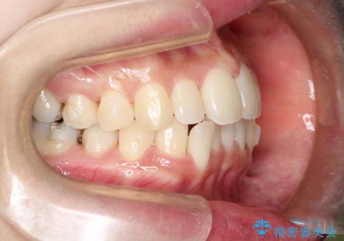 【すきっ歯・引っ込んだ前歯でお悩みの方必見】インビザライン矯正の症例の治療中