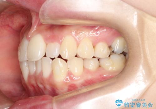 【すきっ歯・引っ込んだ前歯でお悩みの方必見】インビザライン矯正の症例の治療中