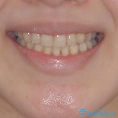 八重歯と前歯の欠損と骨格のズレ　目立たないワイヤー矯正の治療後（顔貌）