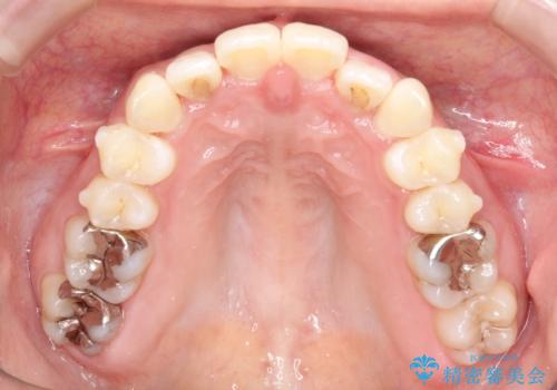 【すきっ歯・引っ込んだ前歯でお悩みの方必見】インビザライン矯正の症例の治療中