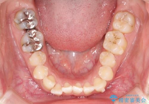 【すきっ歯・引っ込んだ前歯でお悩みの方必見】インビザライン矯正の症例の治療中
