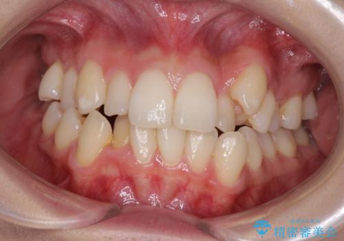 補助装置を併用したインビザラインでの八重歯の抜歯矯正の症例 治療前