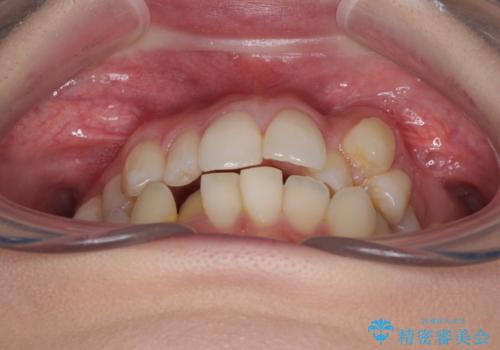 補助装置を併用したインビザラインでの八重歯の抜歯矯正の治療前