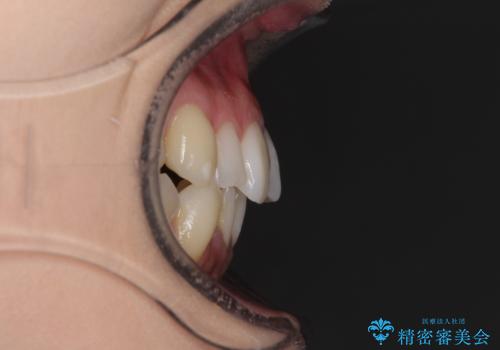 補助装置を併用したインビザラインでの八重歯の抜歯矯正の治療前