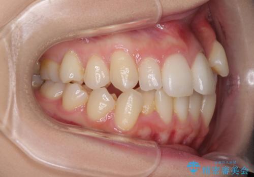 補助装置を併用したインビザラインでの八重歯の抜歯矯正の治療前