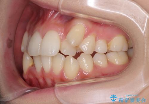 補助装置を併用したインビザラインでの八重歯の抜歯矯正の治療前