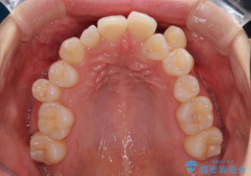 補助装置を併用したインビザラインでの八重歯の抜歯矯正の治療前