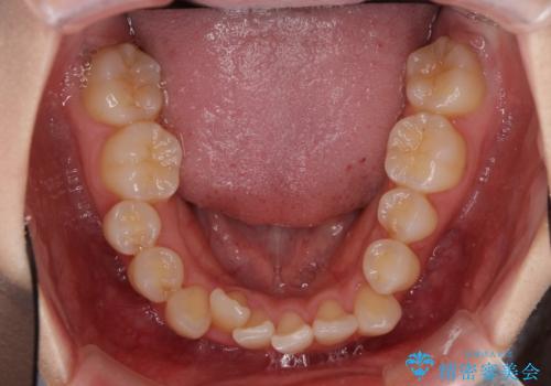 補助装置を併用したインビザラインでの八重歯の抜歯矯正の治療前