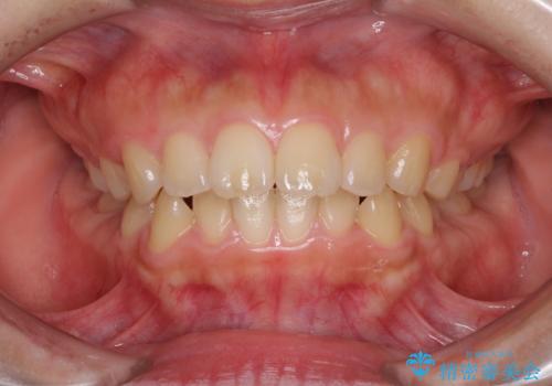 口元を引っ込めたい 目立たないワイヤー装置での抜歯矯正の症例 治療前