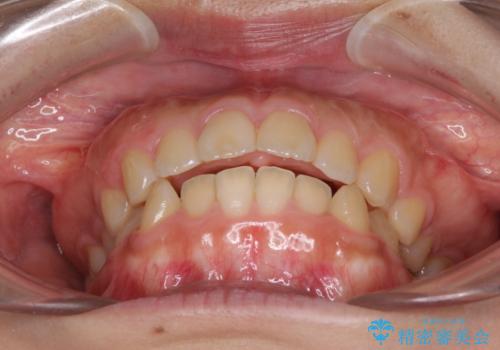 口元を引っ込めたい 目立たないワイヤー装置での抜歯矯正の治療前