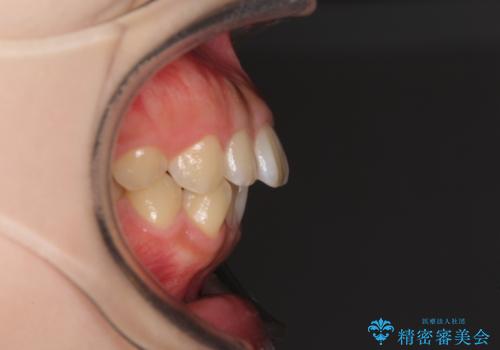 口元を引っ込めたい 目立たないワイヤー装置での抜歯矯正の治療前