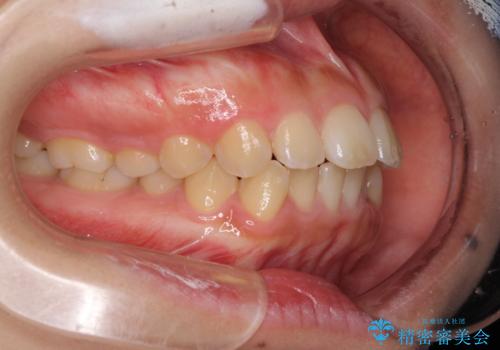 口元を引っ込めたい 目立たないワイヤー装置での抜歯矯正の治療前