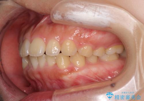 口元を引っ込めたい 目立たないワイヤー装置での抜歯矯正の治療前