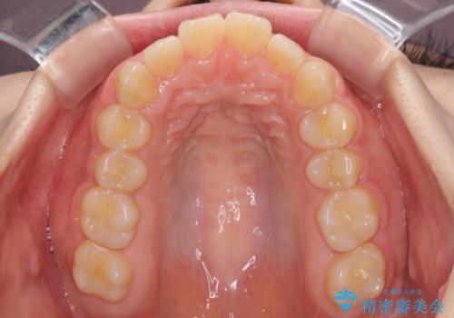 口元を引っ込めたい 目立たないワイヤー装置での抜歯矯正の治療前