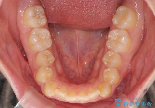 口元を引っ込めたい　目立たないワイヤー装置での抜歯矯正の治療前