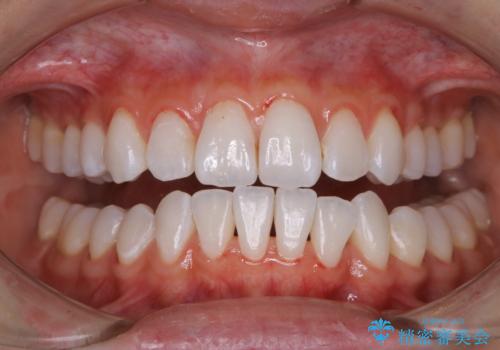 着色落とし、クリーニング(PMTC)の治療後