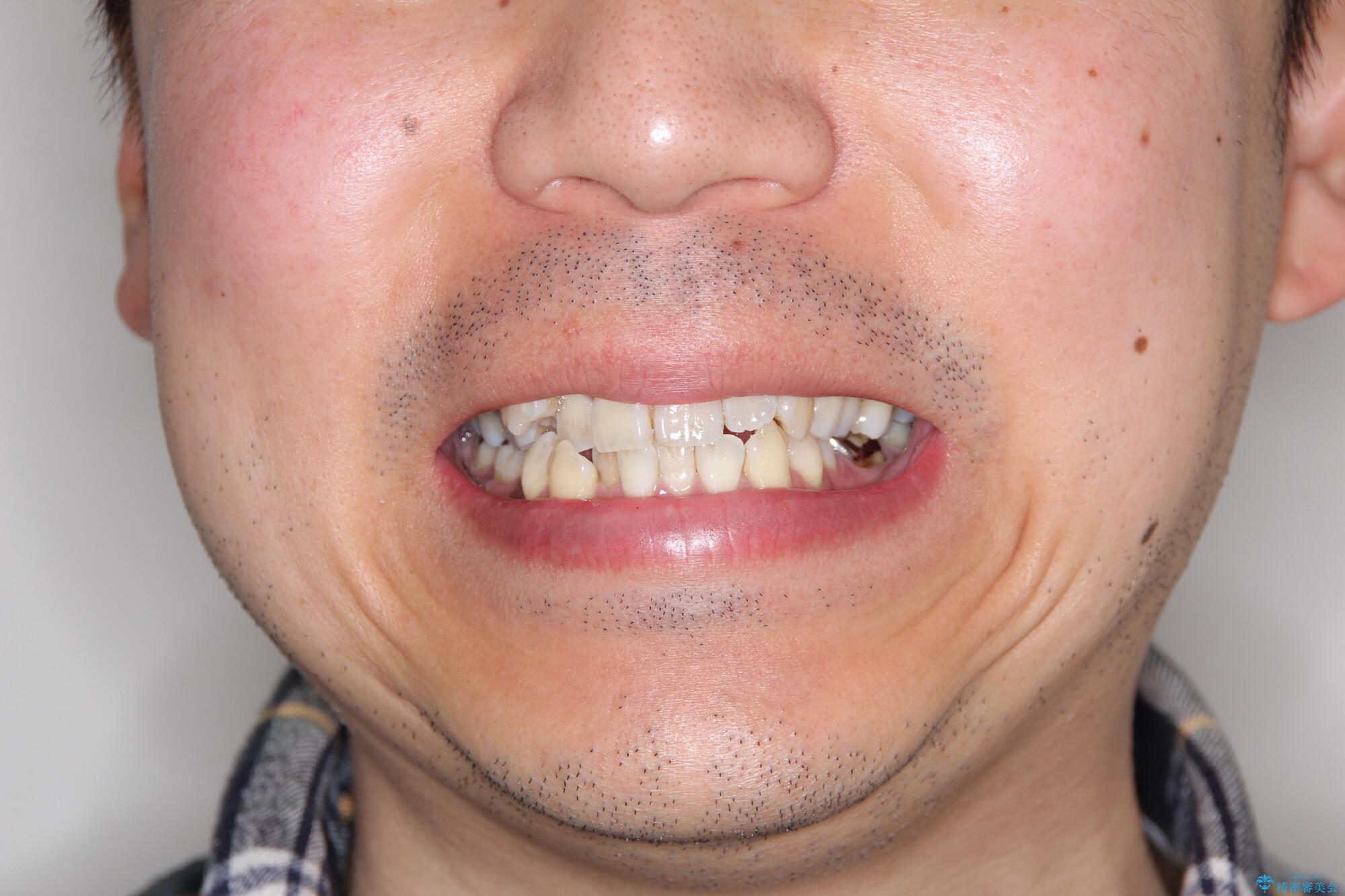 飛び出た八重歯!コンプレックスを払拭!の治療前(顔貌)
