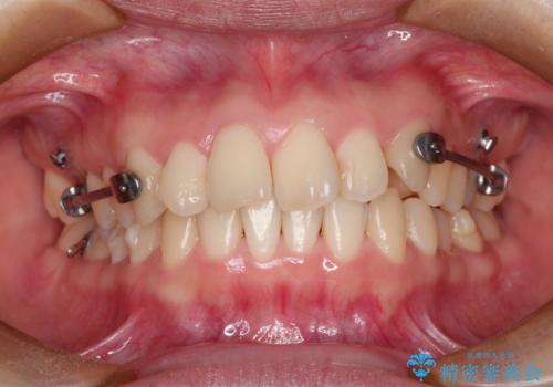 【出っ歯(飛び出した前歯)・がたつきでお悩みの方必見】インビザライン矯正の症例の治療中