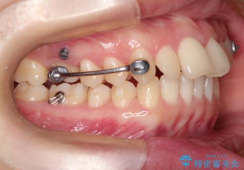 【出っ歯(飛び出した前歯)・がたつきでお悩みの方必見】インビザライン矯正の症例の治療中