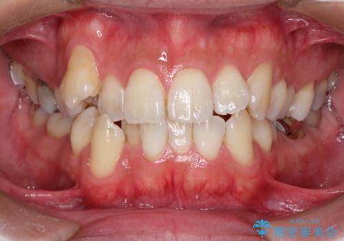 飛び出た八重歯!コンプレックスを払拭!の治療前
