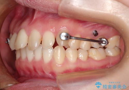 【出っ歯(飛び出した前歯)・がたつきでお悩みの方必見】インビザライン矯正の症例の治療中