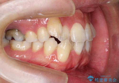 飛び出た八重歯!コンプレックスを払拭!の治療前