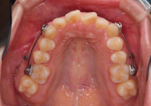 【出っ歯(飛び出した前歯)・がたつきでお悩みの方必見】インビザライン矯正の症例の治療中