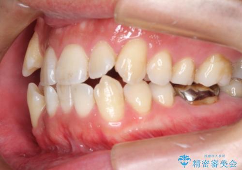 飛び出た八重歯!コンプレックスを払拭!の治療前