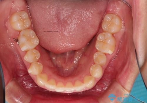 【出っ歯(飛び出した前歯)・がたつきでお悩みの方必見】インビザライン矯正の症例の治療中