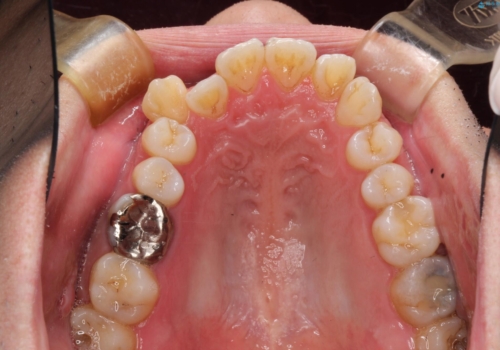 飛び出た八重歯!コンプレックスを払拭!の治療前