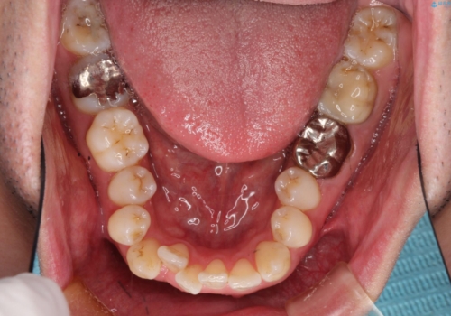 飛び出た八重歯!コンプレックスを払拭!の治療前