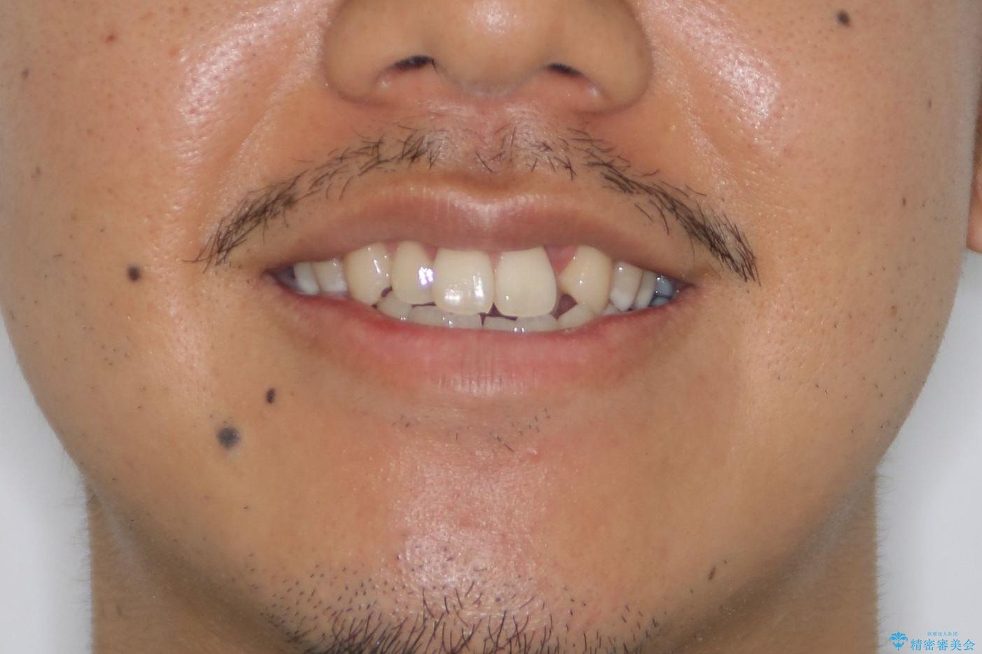 【MSE+インビザライン】前歯のガタガタの治療前（顔貌）